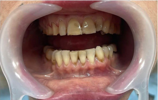 Before treatment 1