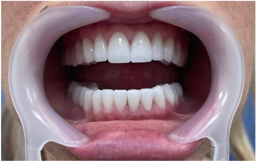 After treatment 1